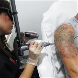Eliminación de tatuaje en Córdoba